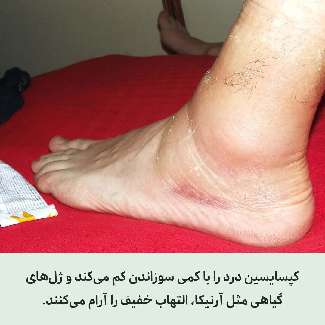 کپسایسین، لیدوکائین و پماد گیاهی برای کمر درد