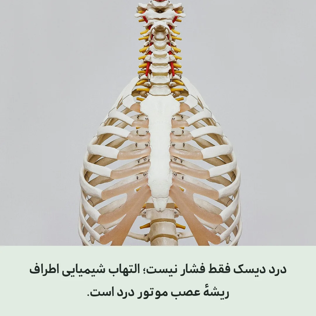 دیسک کمر چه دردی می‌سازد و چرا التهاب نقش اول را بازی می‌کند؟