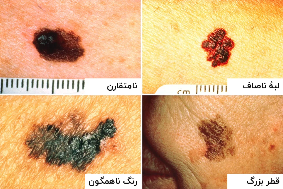 چهار عکس نزدیک از ملانوما با برچسب فارسی نامتقارن، لبهٔ ناصاف، رنگ ناهمگون و قطر بزرگ