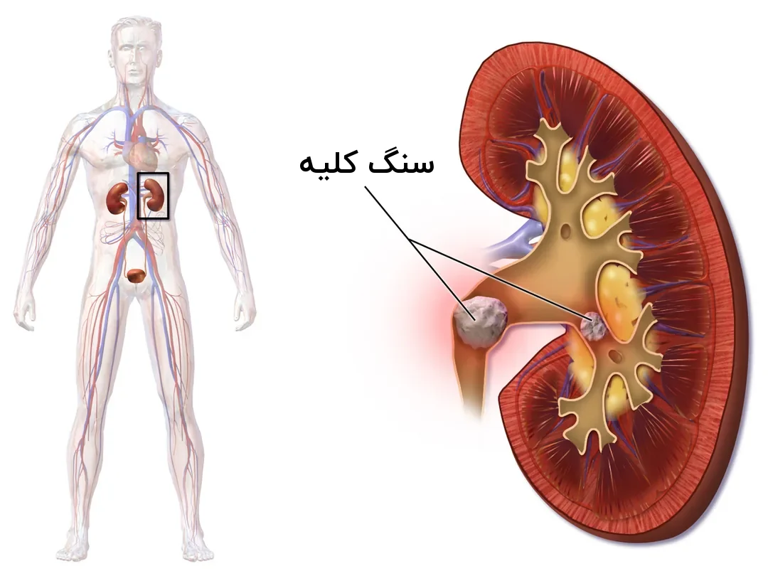 برش یک کلیه که دو سنگ را در لگنچه و محل خروج ادرار نشان می‌دهد، کنار شکل کلی بدن