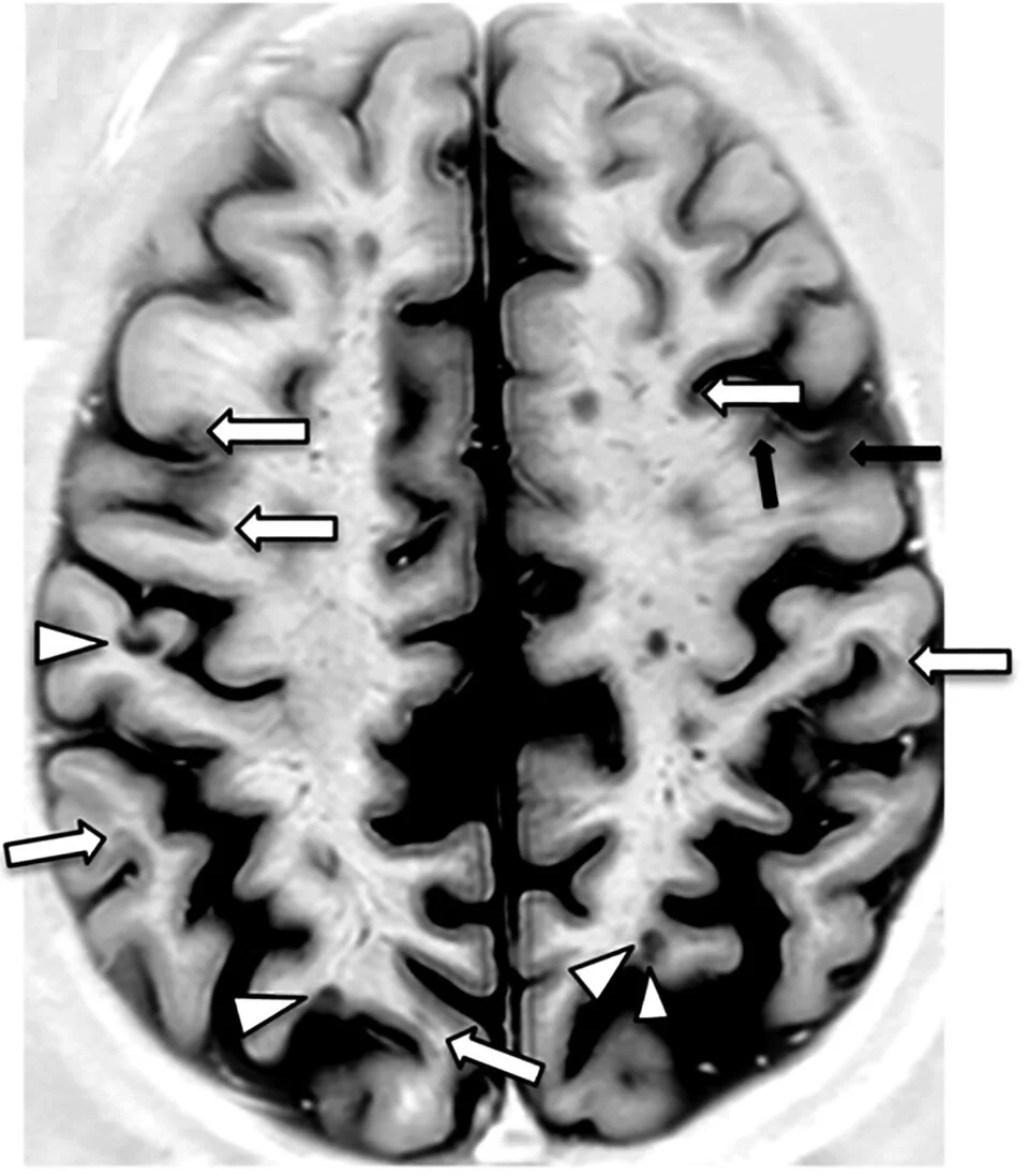 برش MRI مغز یک فرد مبتلا به ام‌اس که پیکان‌ها لکه‌های تیرهٔ بیماری را نشان می‌دهند