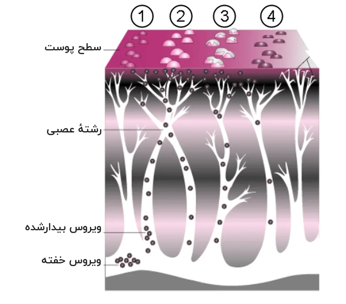 برش شماتیک پوست و عصب: ویروس خفته در ریشهٔ عصب، ویروس بیدارشده در مسیر رشتهٔ عصبی و تاولها روی سطح پوست