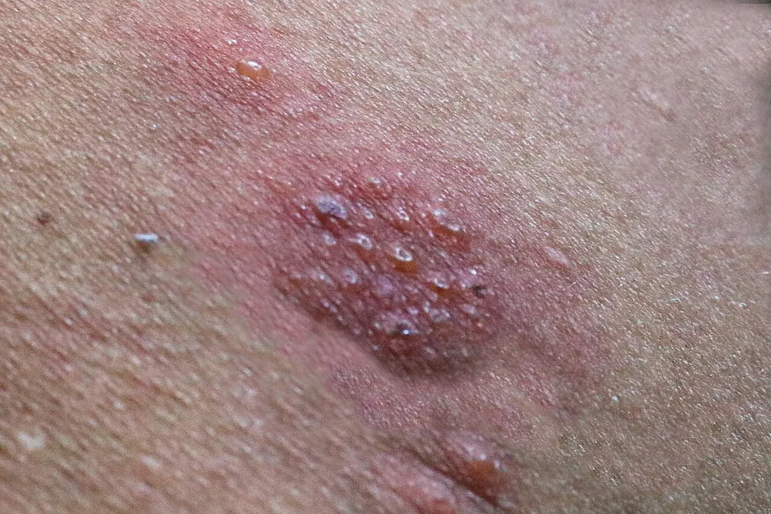 خوشهٔ تاولهای پرآب روی زمینهٔ قرمز در پوست یک بیمار مبتلا به زونا
